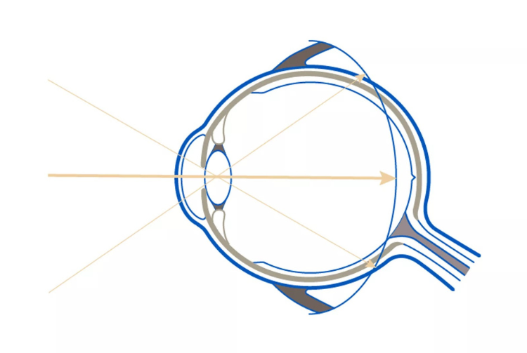schema de l'oeil myope réalisé par seiko pour le verre miyosmart